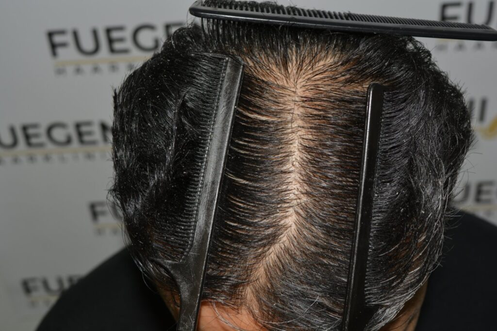 Hairline Midscalp Crown