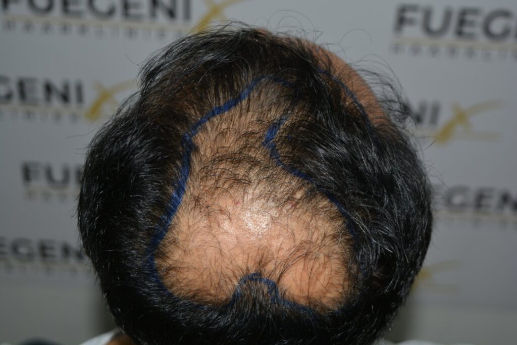 Hairline Midscalp Crown