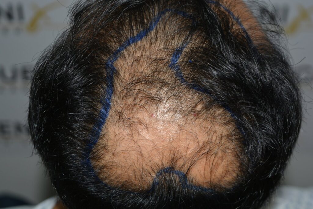 Hairline Midscalp Crown