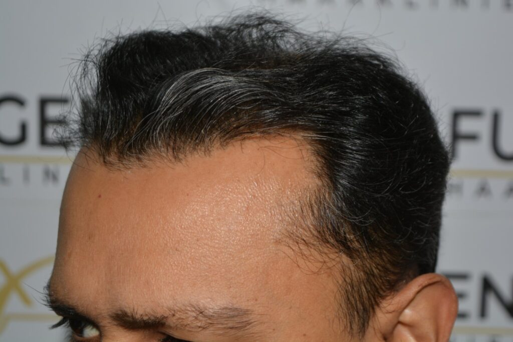 Hairline Midscalp Crown
