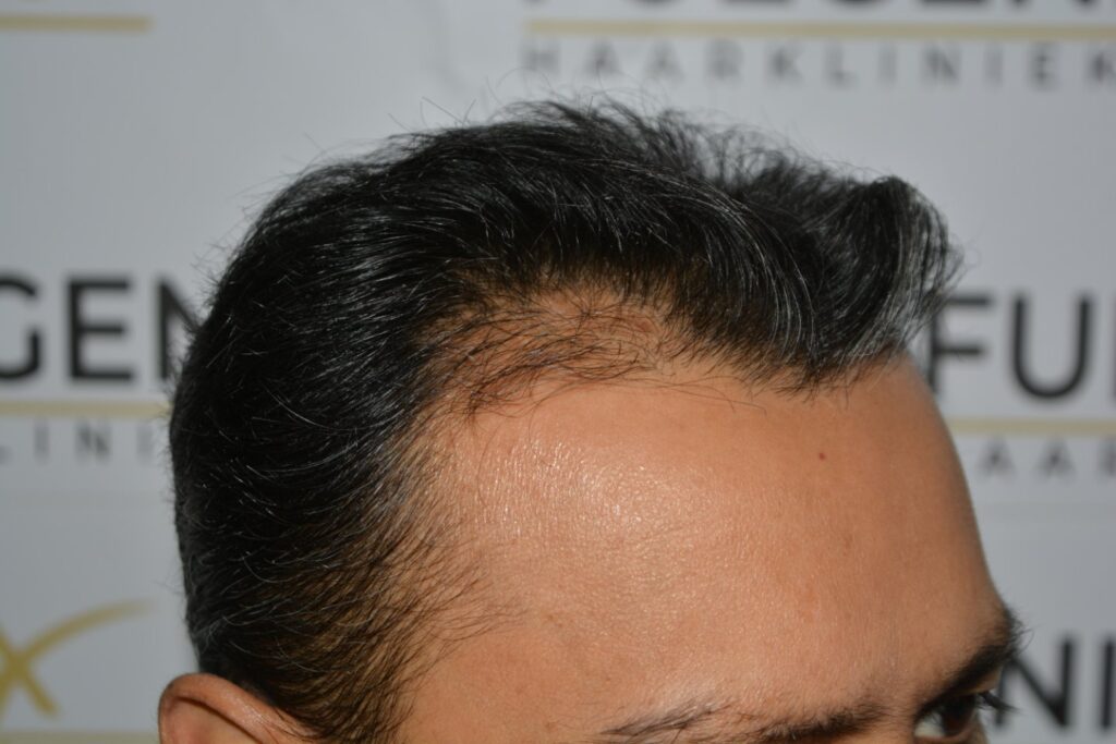 Hairline Midscalp Crown