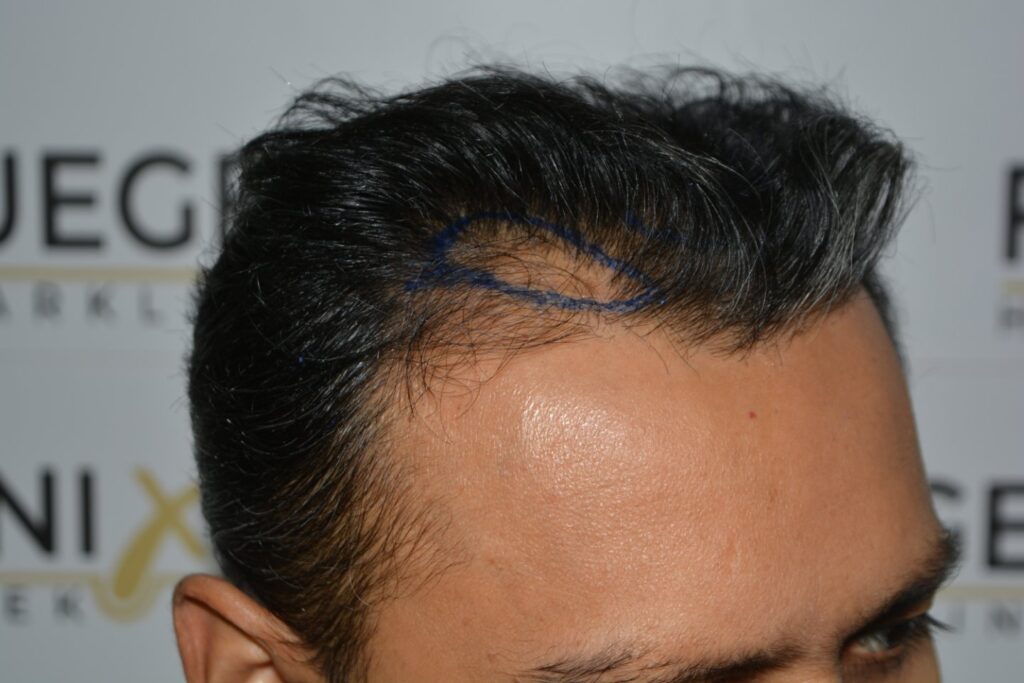 Hairline Midscalp Crown