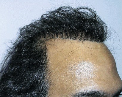 Close-up of a pluggy hairline resulting from an old-style plug hair transplant