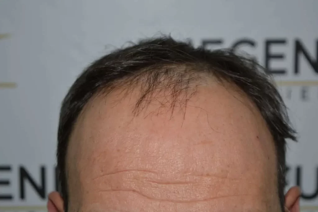 Salt And Pepper Hairline