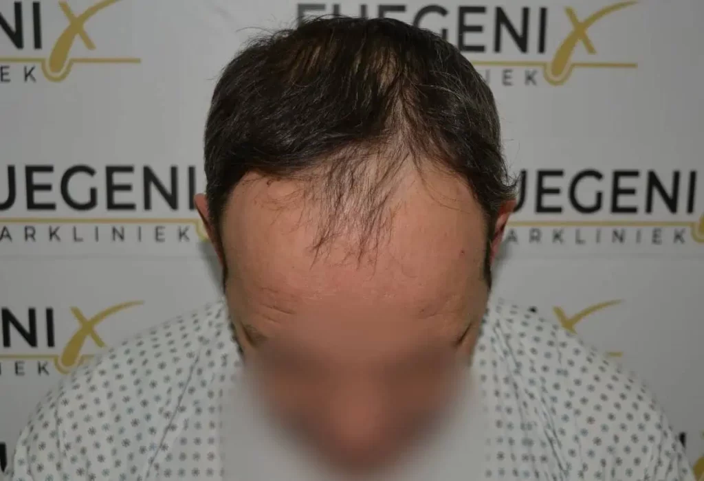 Salt And Pepper Hairline