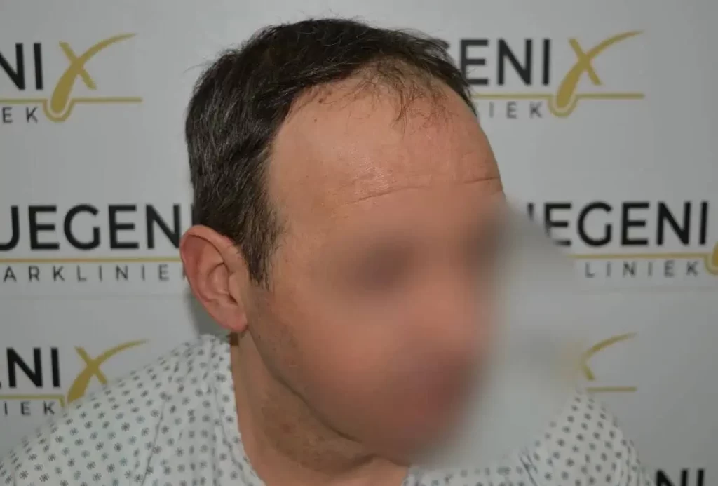Salt And Pepper Hairline