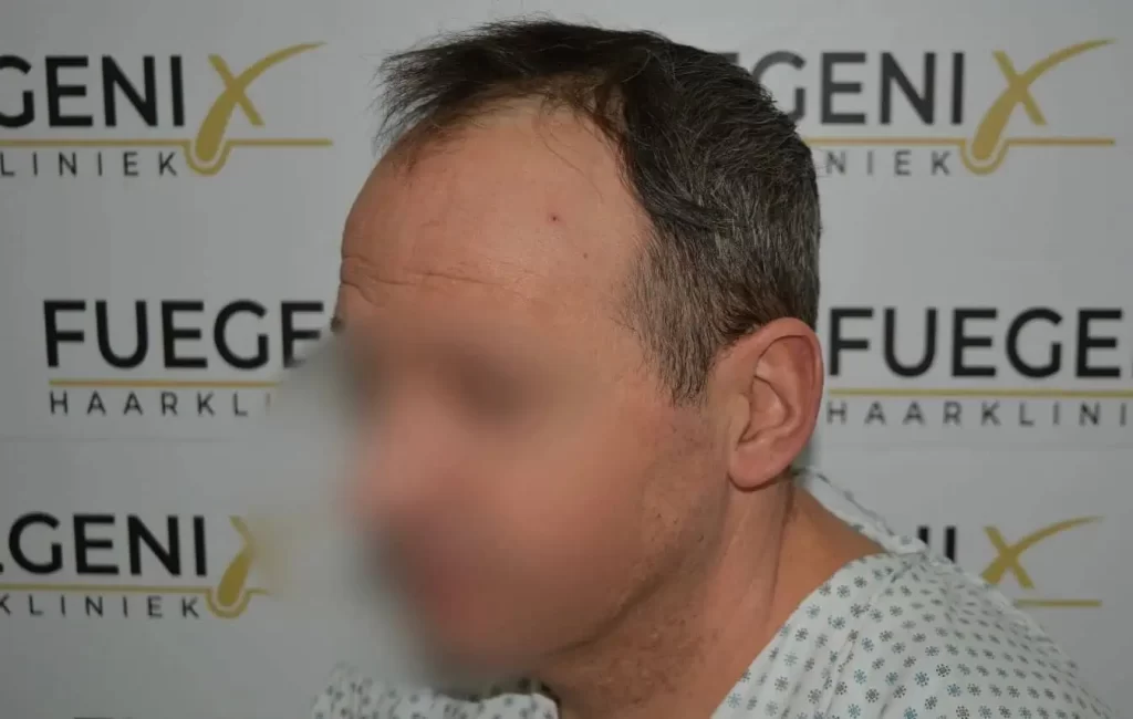 Salt And Pepper Hairline