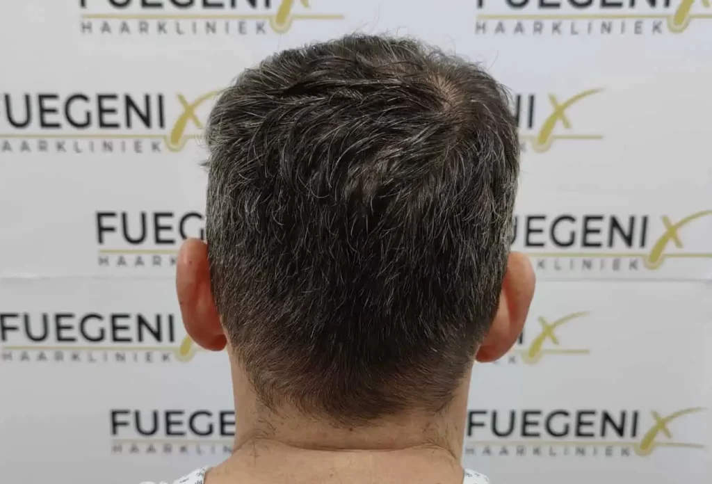 Salt And Pepper Hairline