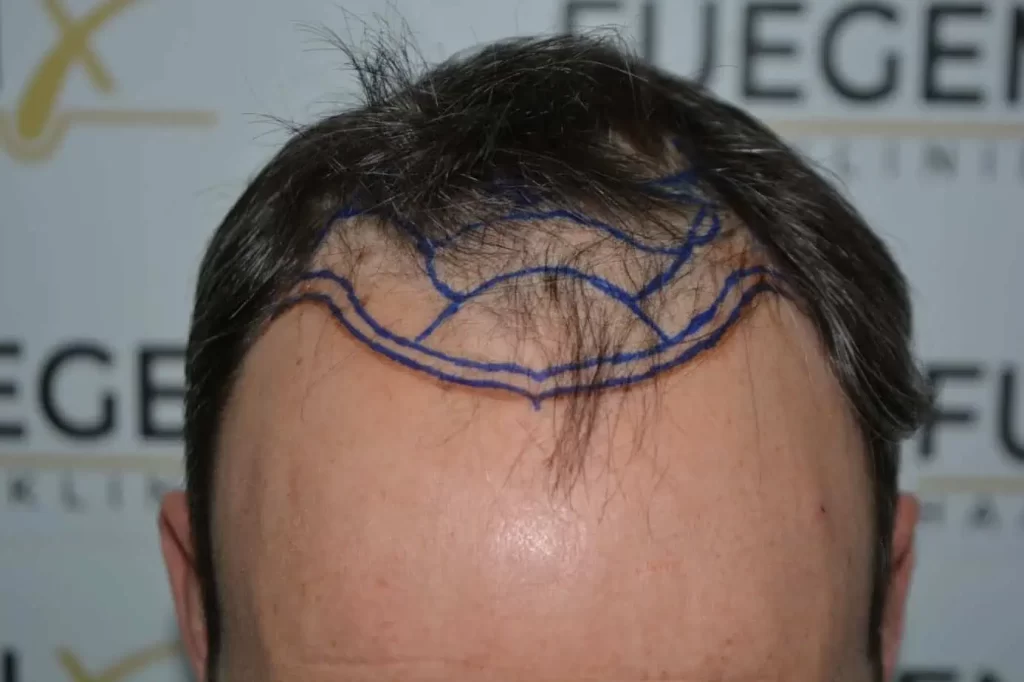 Salt And Pepper Hairline