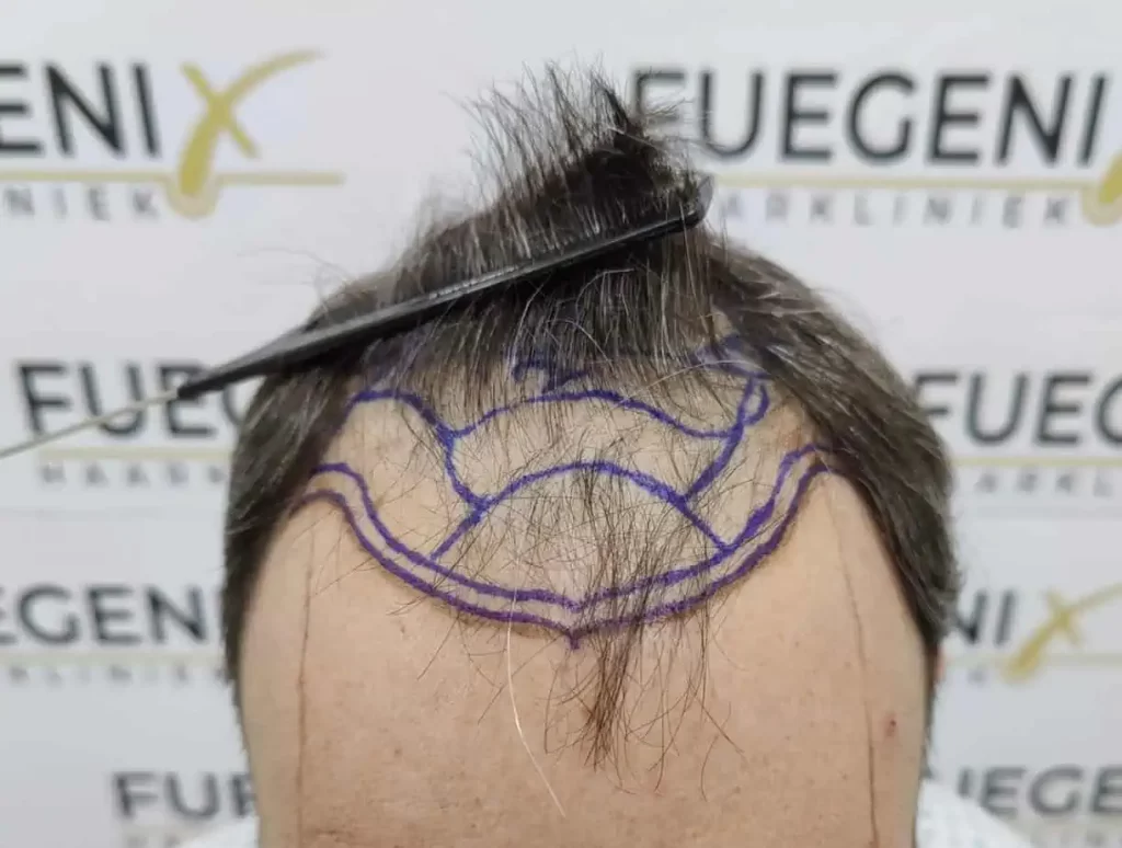Salt And Pepper Hairline