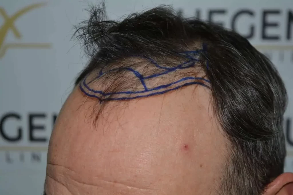 Salt And Pepper Hairline