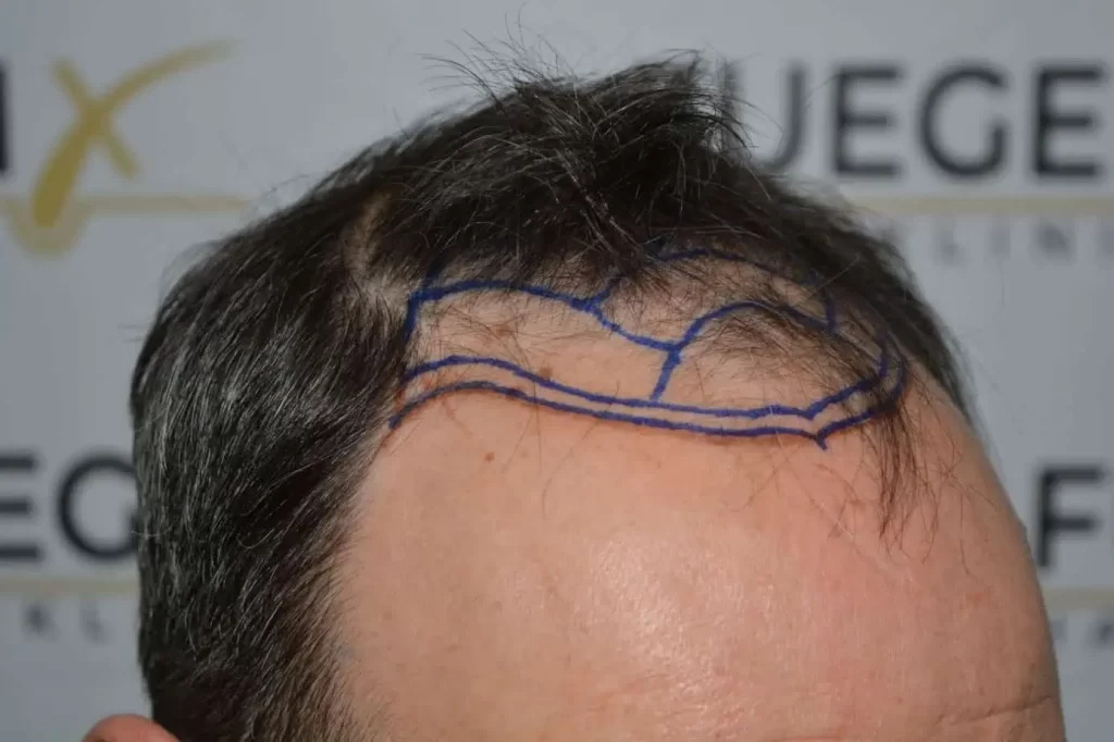 Salt And Pepper Hairline
