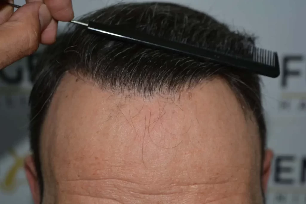 Salt And Pepper Hairline