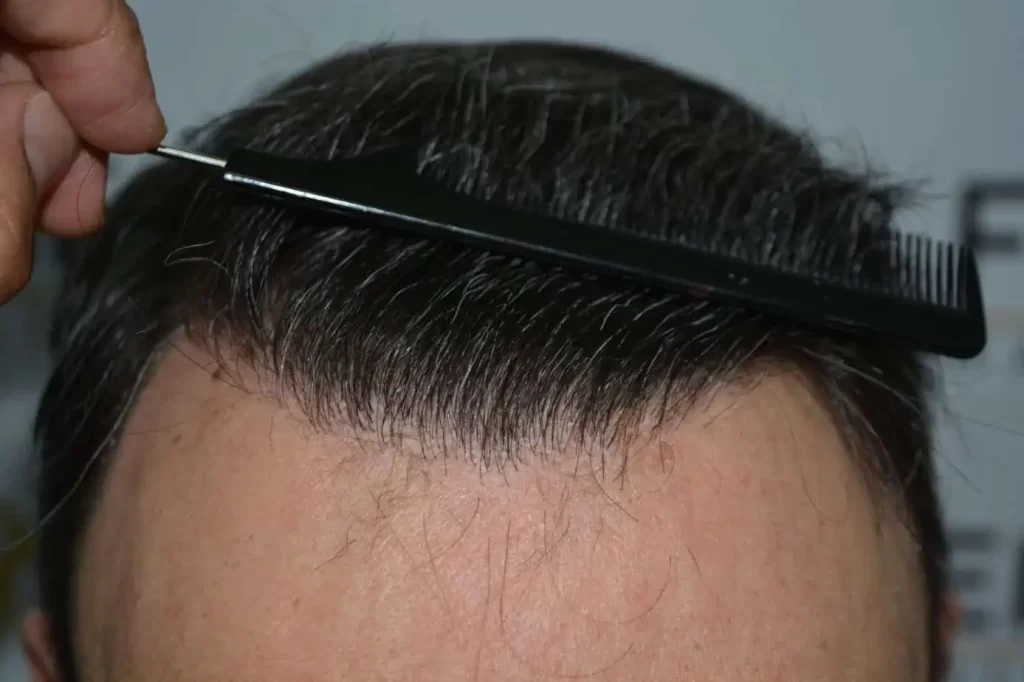 Salt And Pepper Hairline