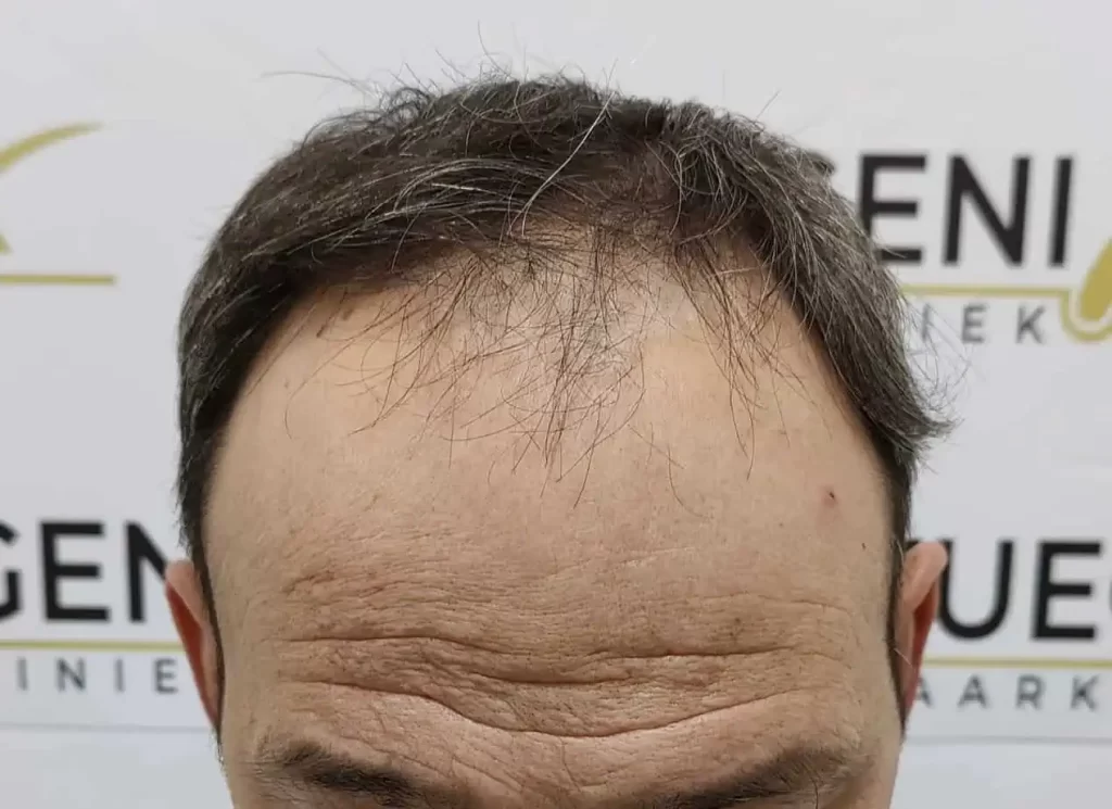 Salt And Pepper Hairline