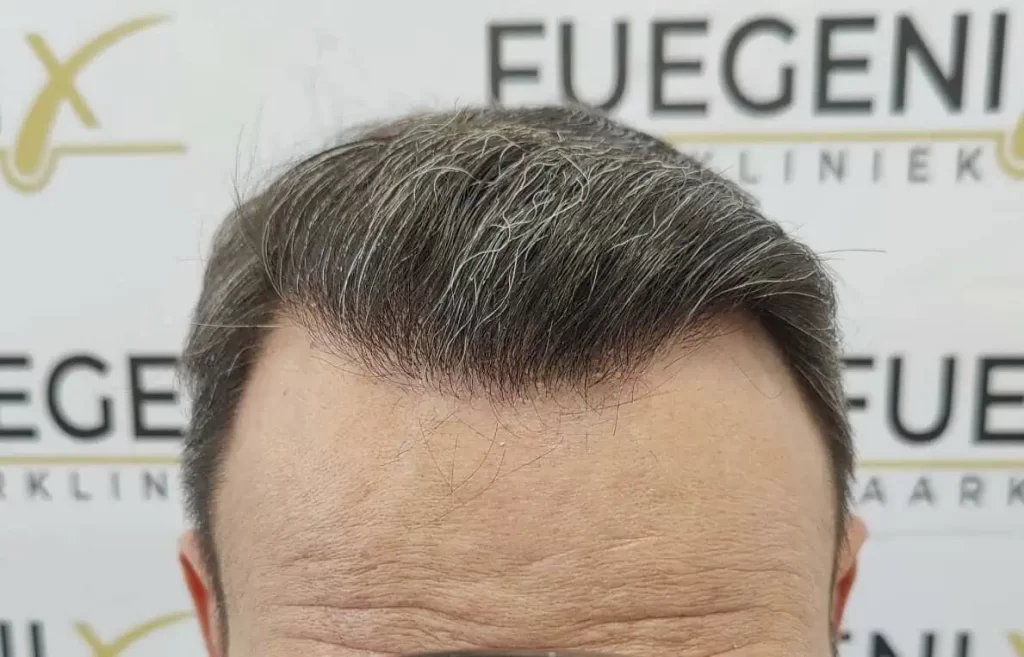 Salt And Pepper Hairline