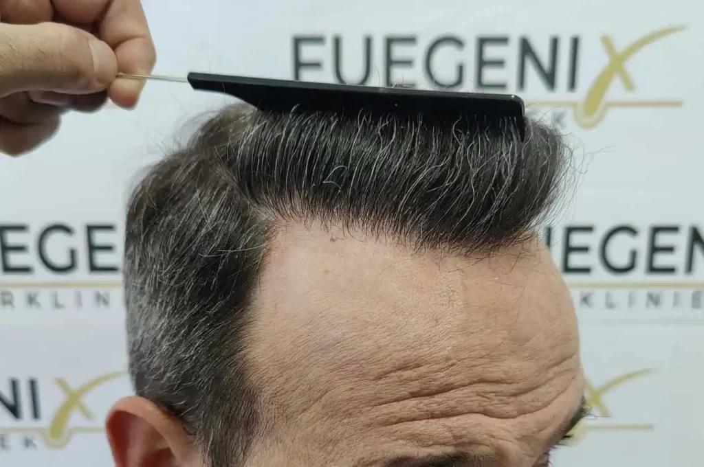 Salt And Pepper Hairline