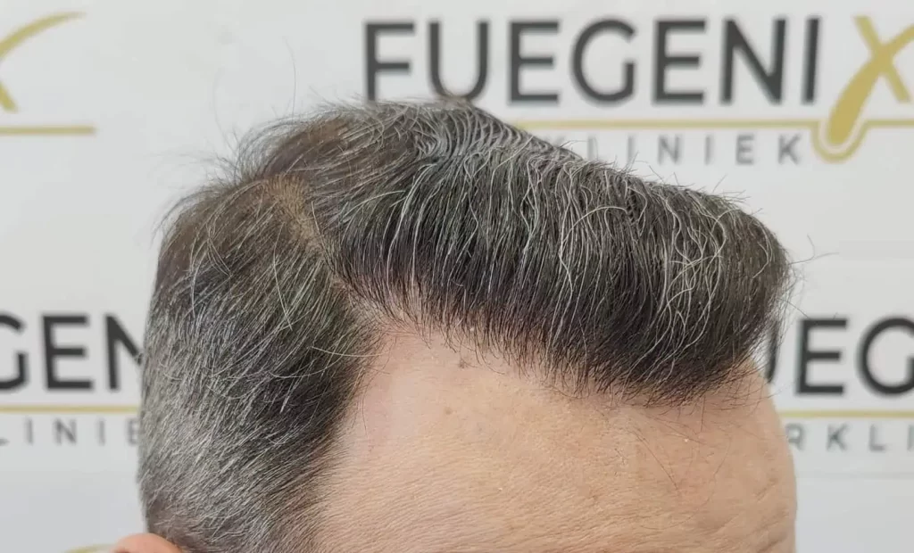 Salt And Pepper Hairline