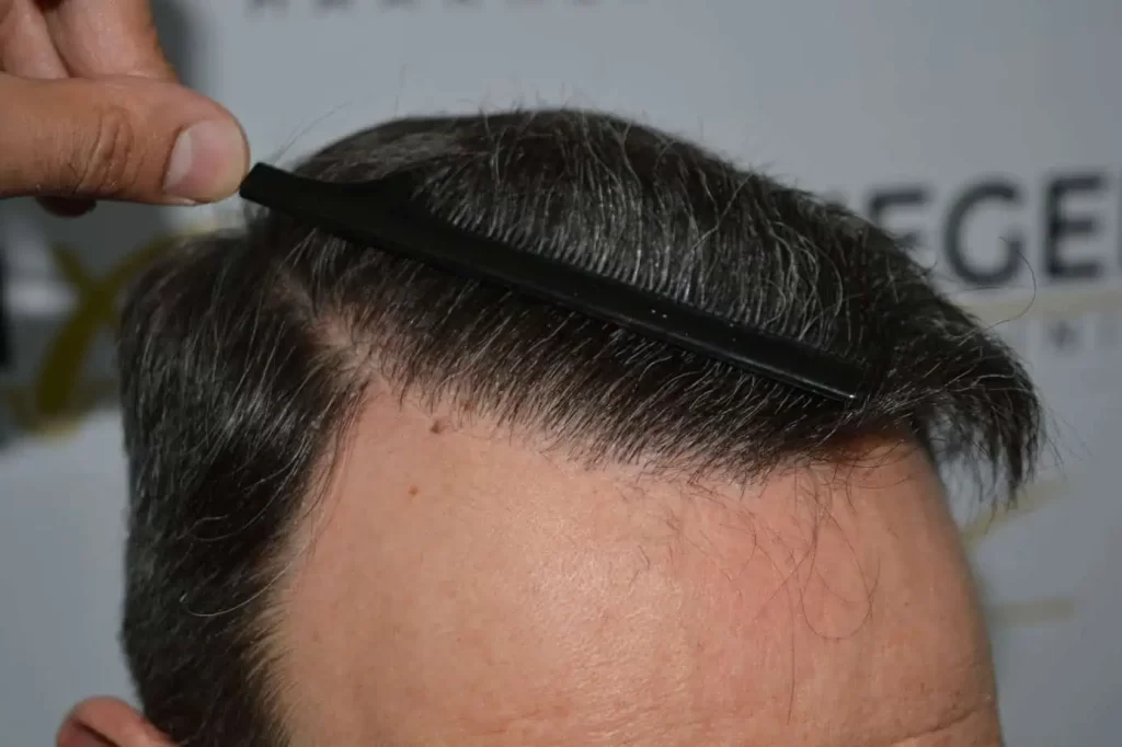 Salt And Pepper Hairline