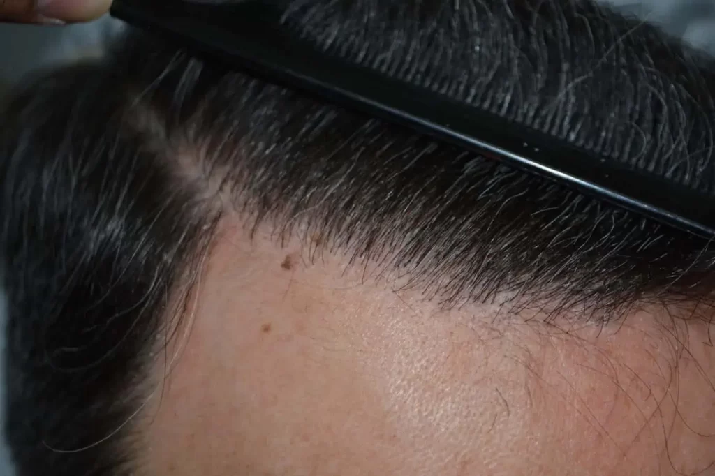 Salt And Pepper Hairline