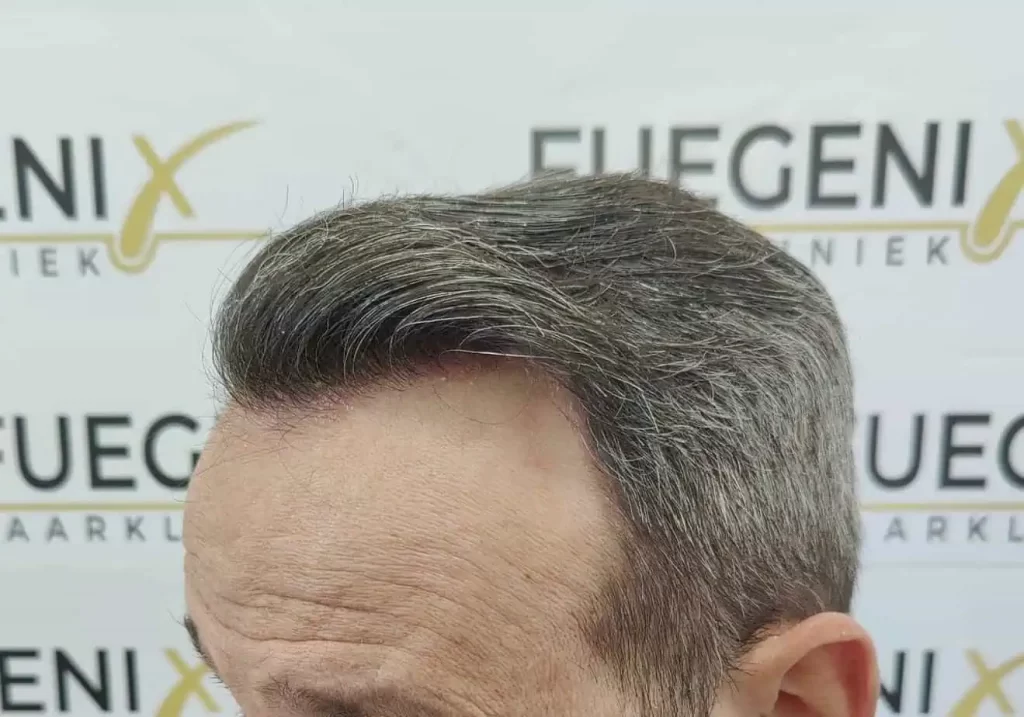 Salt And Pepper Hairline
