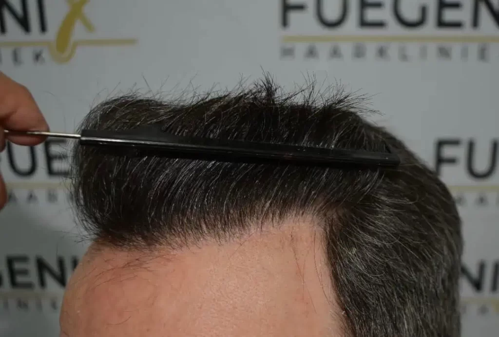 Salt And Pepper Hairline
