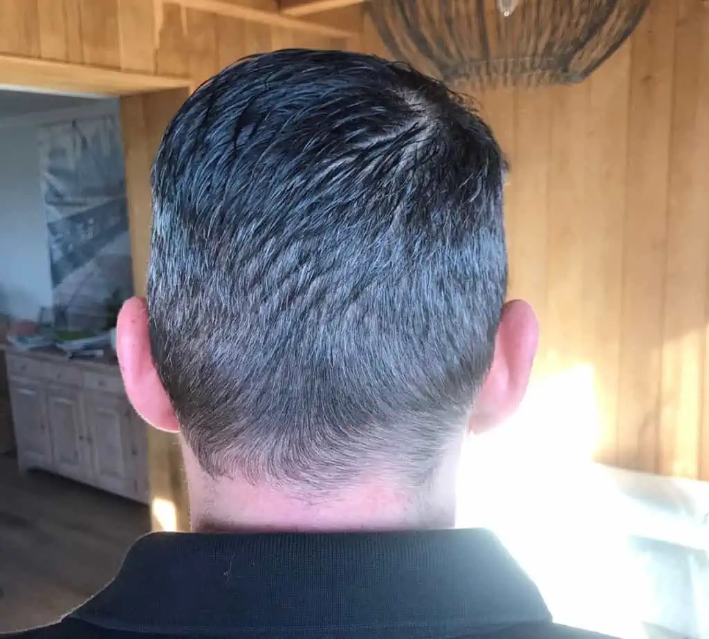 Salt And Pepper Hairline