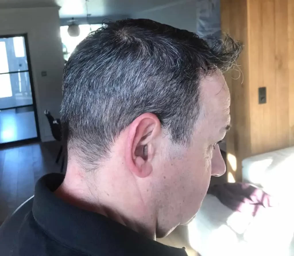 Salt And Pepper Hairline