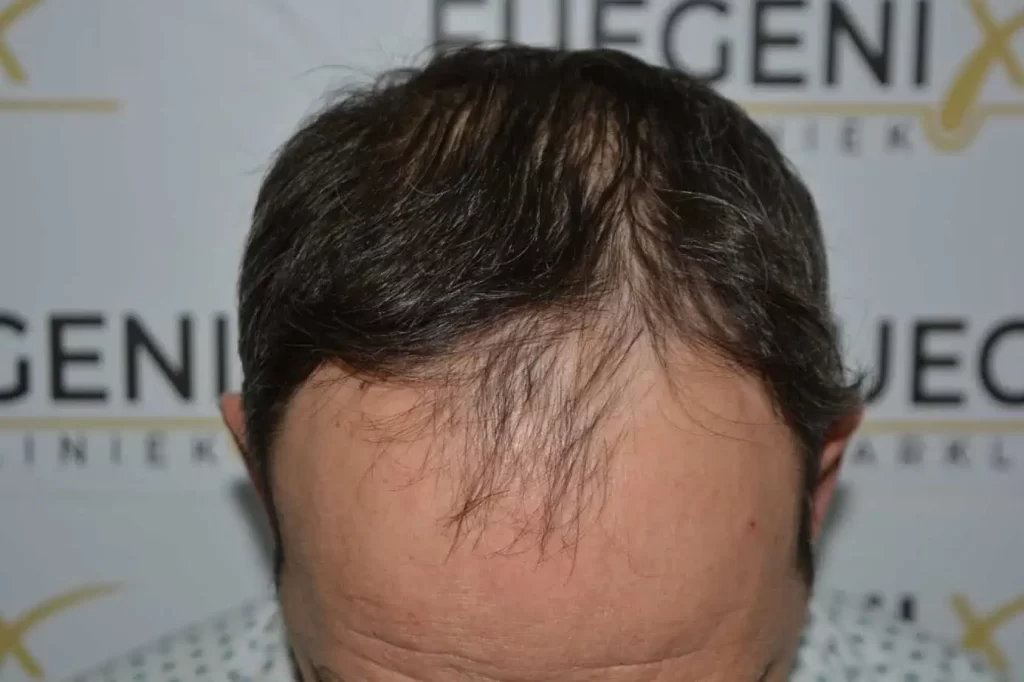 Salt And Pepper Hairline
