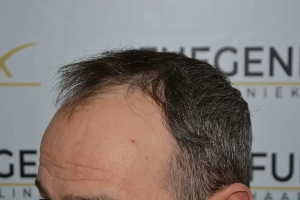Salt And Pepper Hairline