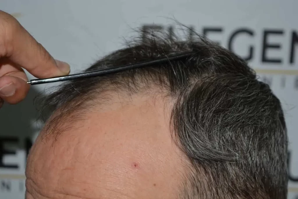 Salt And Pepper Hairline
