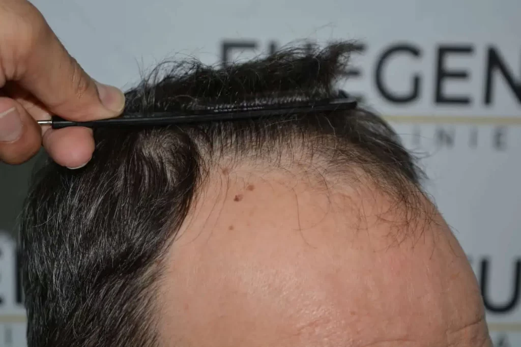 Salt And Pepper Hairline