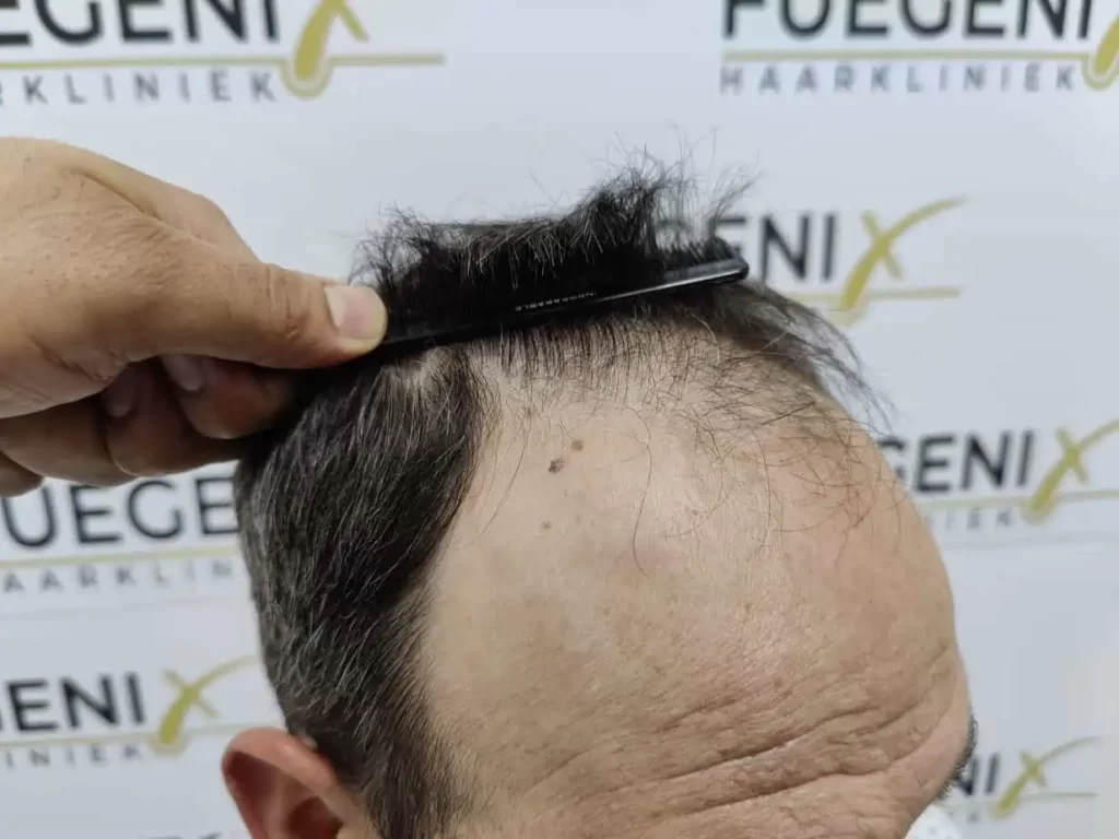 Salt And Pepper Hairline