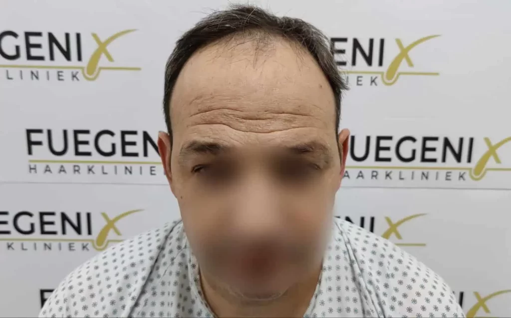 Salt And Pepper Hairline