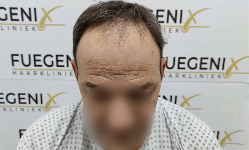 Salt And Pepper Hairline