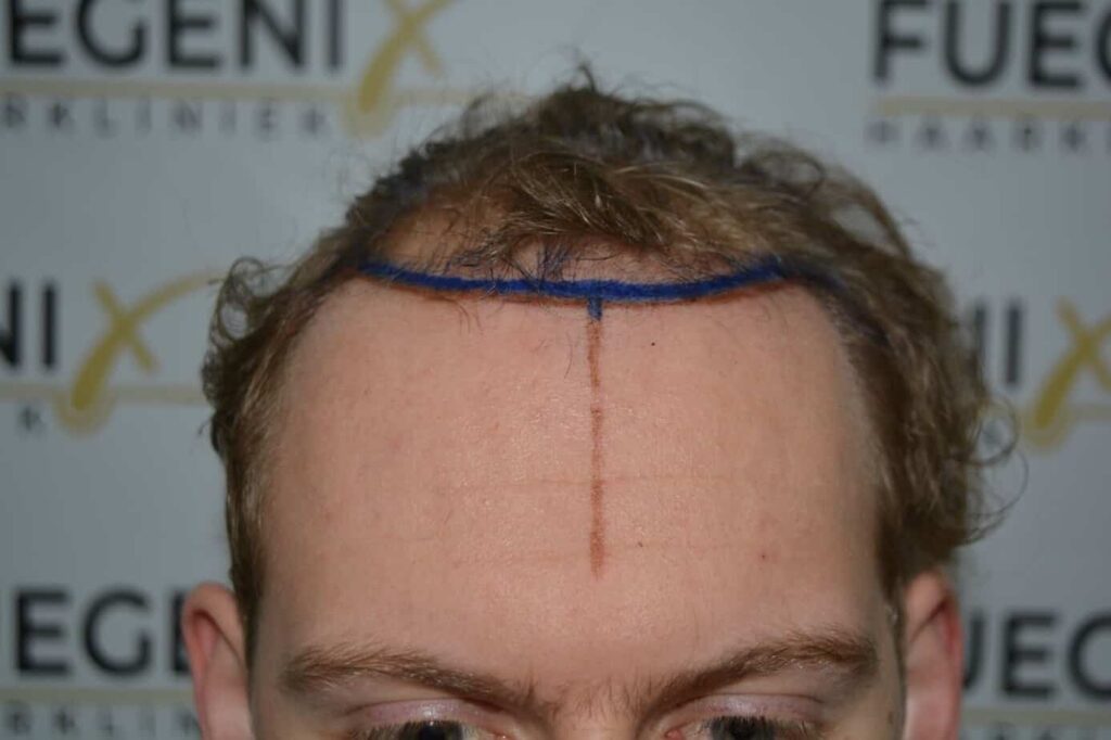 Soft Dense Hairline