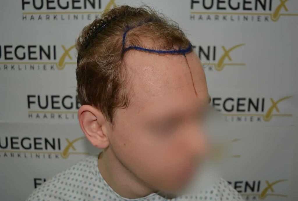 Soft Dense Hairline