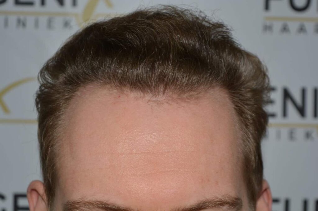 Soft Dense Hairline