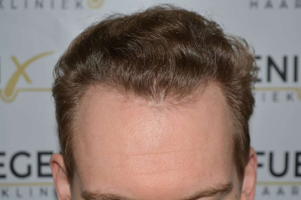 Soft Dense Hairline