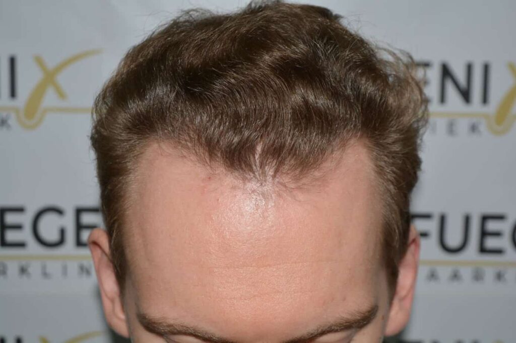 Soft Dense Hairline