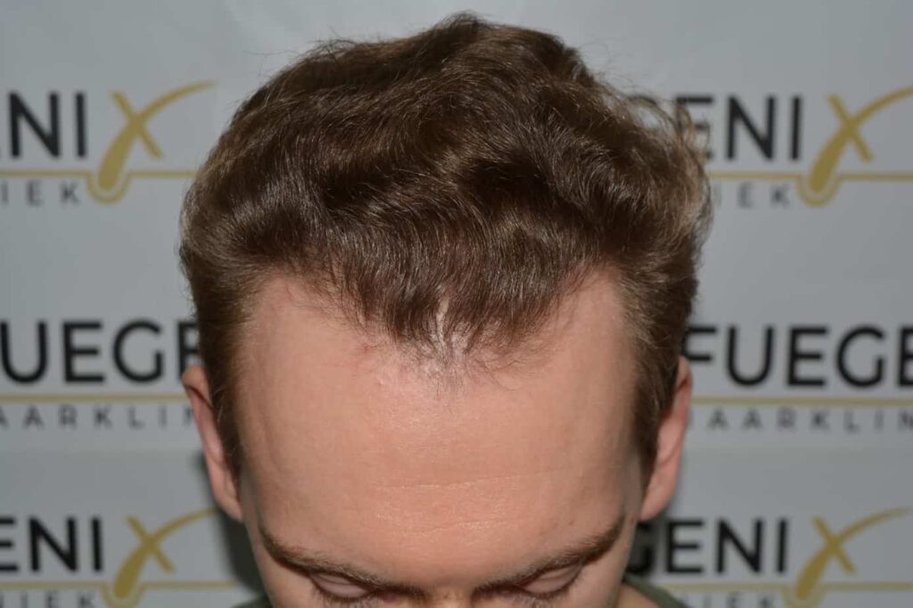 Soft Dense Hairline