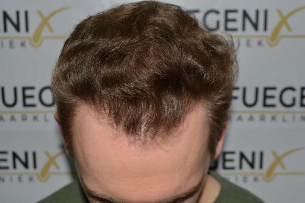Soft Dense Hairline