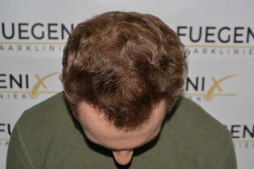 Soft Dense Hairline