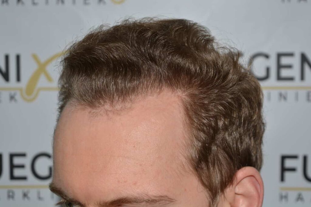 Soft Dense Hairline