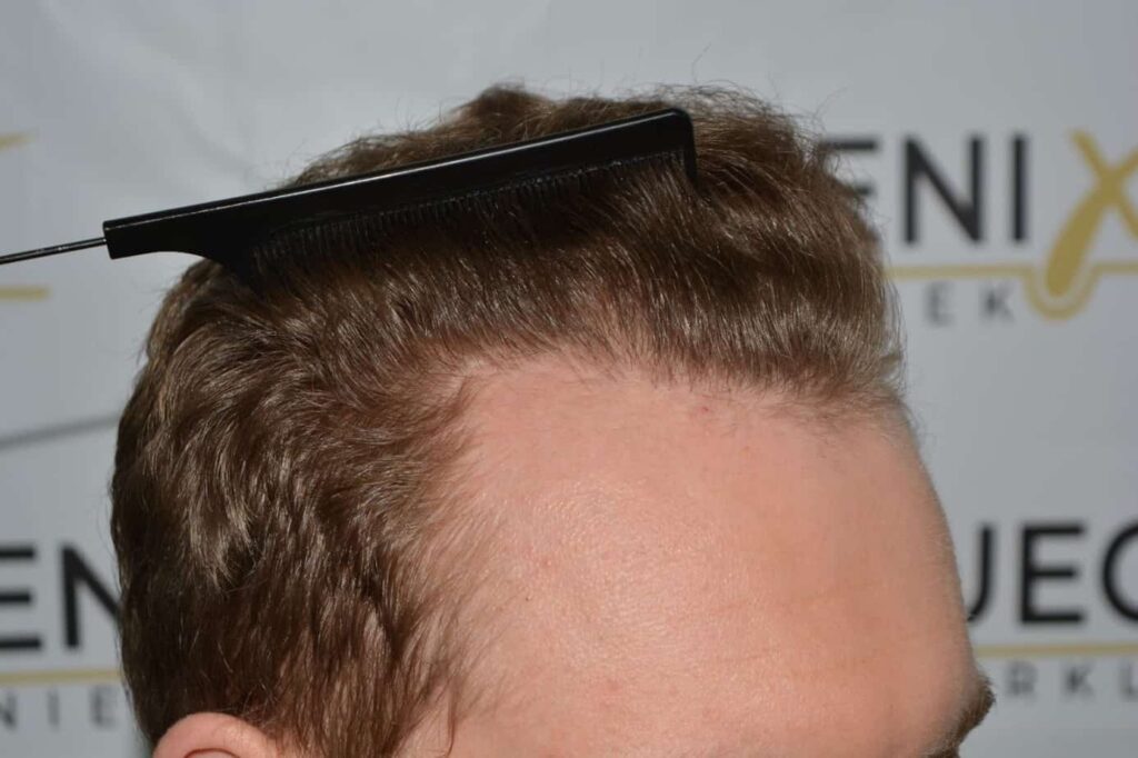Soft Dense Hairline