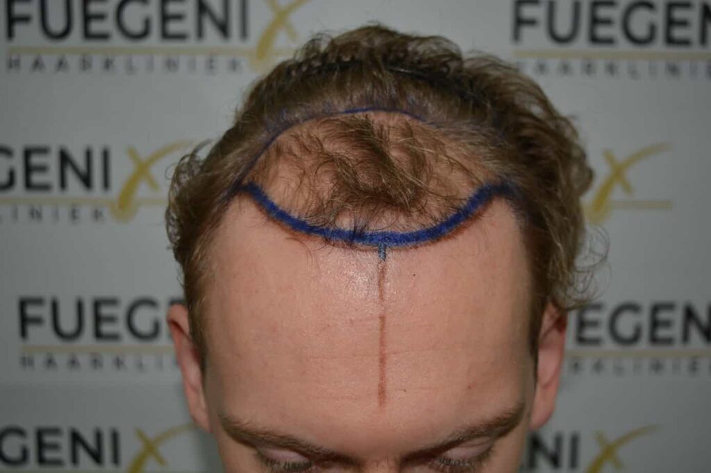 Soft Dense Hairline