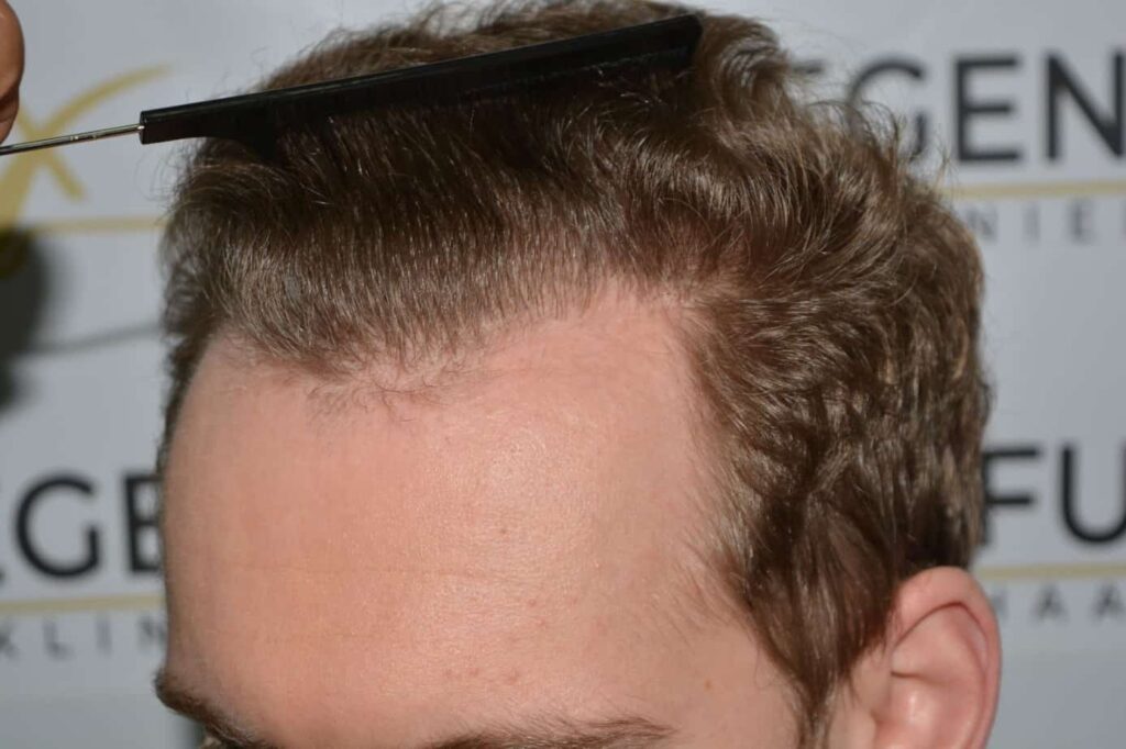 Soft Dense Hairline