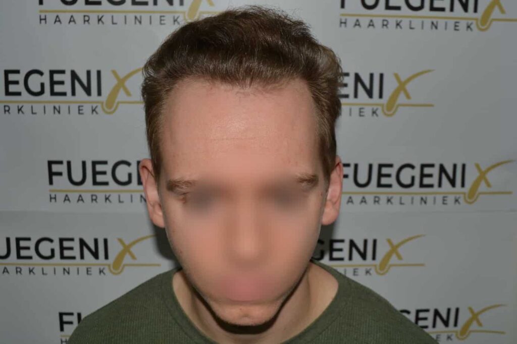 Soft Dense Hairline