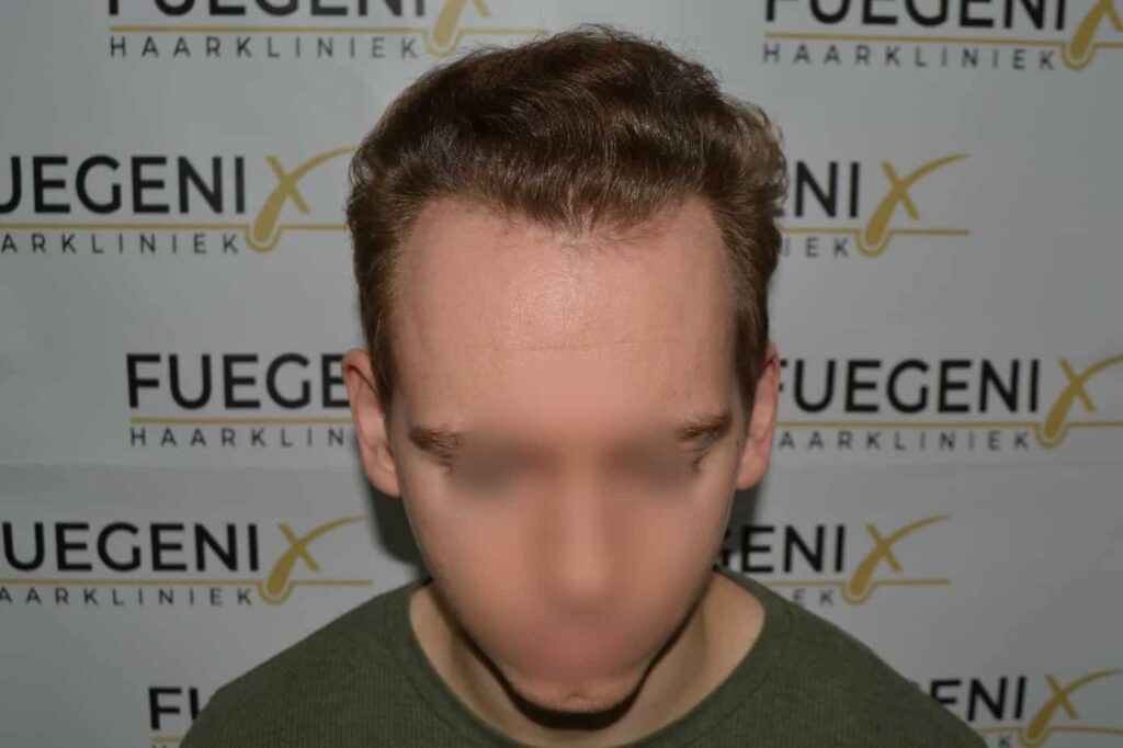 Soft Dense Hairline