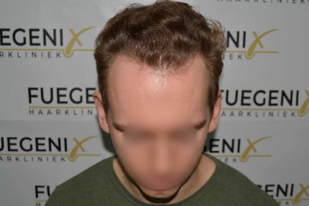 Soft Dense Hairline